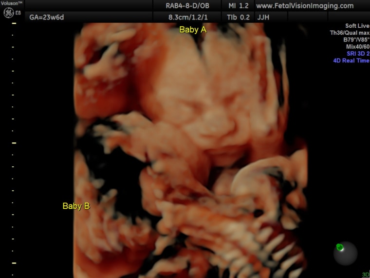Twins kissing in ultrasound photo