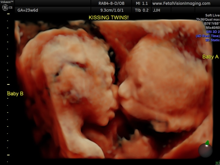 Baby twins kissing in the womb ultrasound