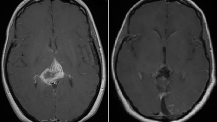 Woman survives deadly brain tumor.