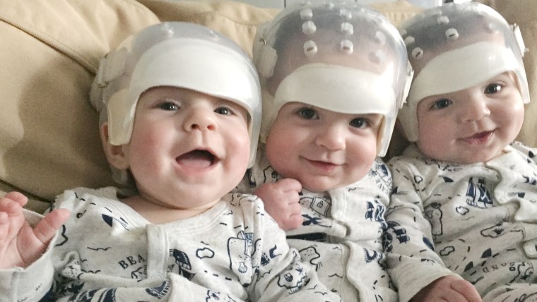 The Howard triplets, all born with craniosynostosis.