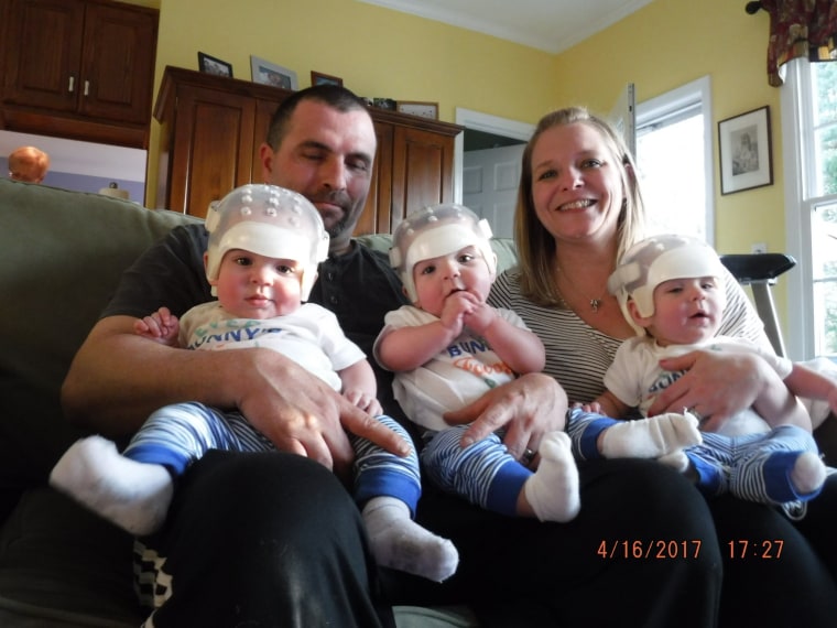 Howard triplets, all born with craniosynostosis.