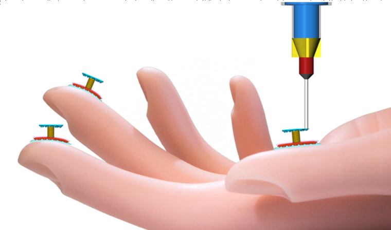 The 3D printed sensors consist of a coil between two flat electrodes, a layer of pure silicon between the skin and the electrode, and a sacrificial layer that holds up the top layer while it sets.