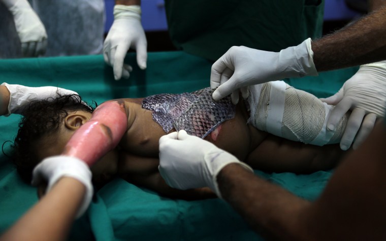 Image: The Wider Image: Healing burns with fish skin