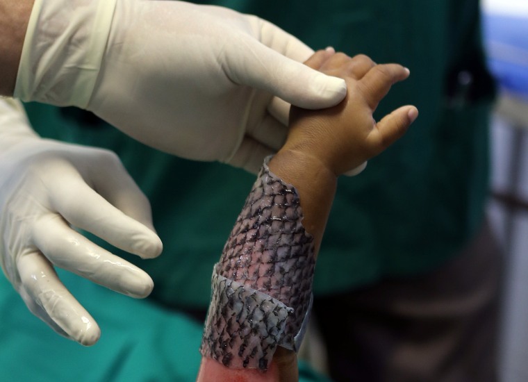 Image: The Wider Image: Healing burns with fish skin