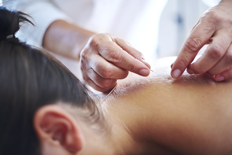 Image: Acupuncturist applying acupuncture needles to womans neck