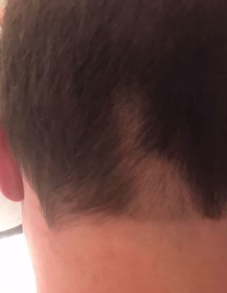 Dylan's husband Brian Fichera now has a bald spot on the back of his head. 