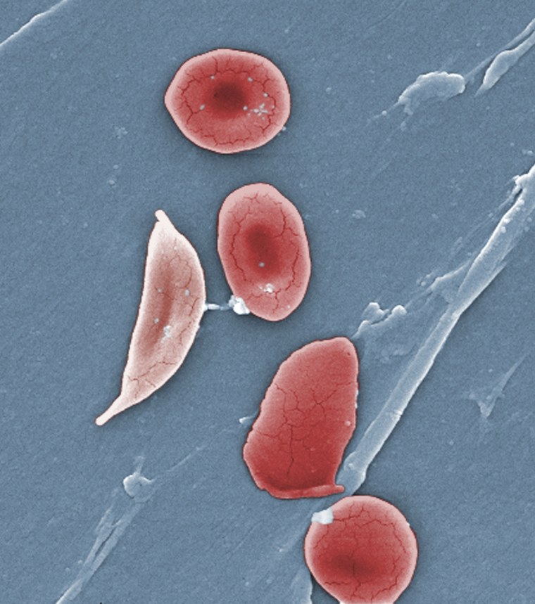 This 2009 colorized microscope image made available by the Sickle Cell Foundation of Georgia via the Centers for Disease Control and Prevention shows a sickle cell, left, and normal red blood cells of a patient with sickle cell anemia.