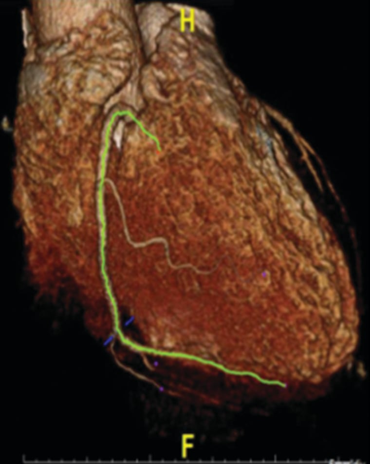 A newly developed imaging method identifies inflamed artery lesions that pose the most risk to patients.