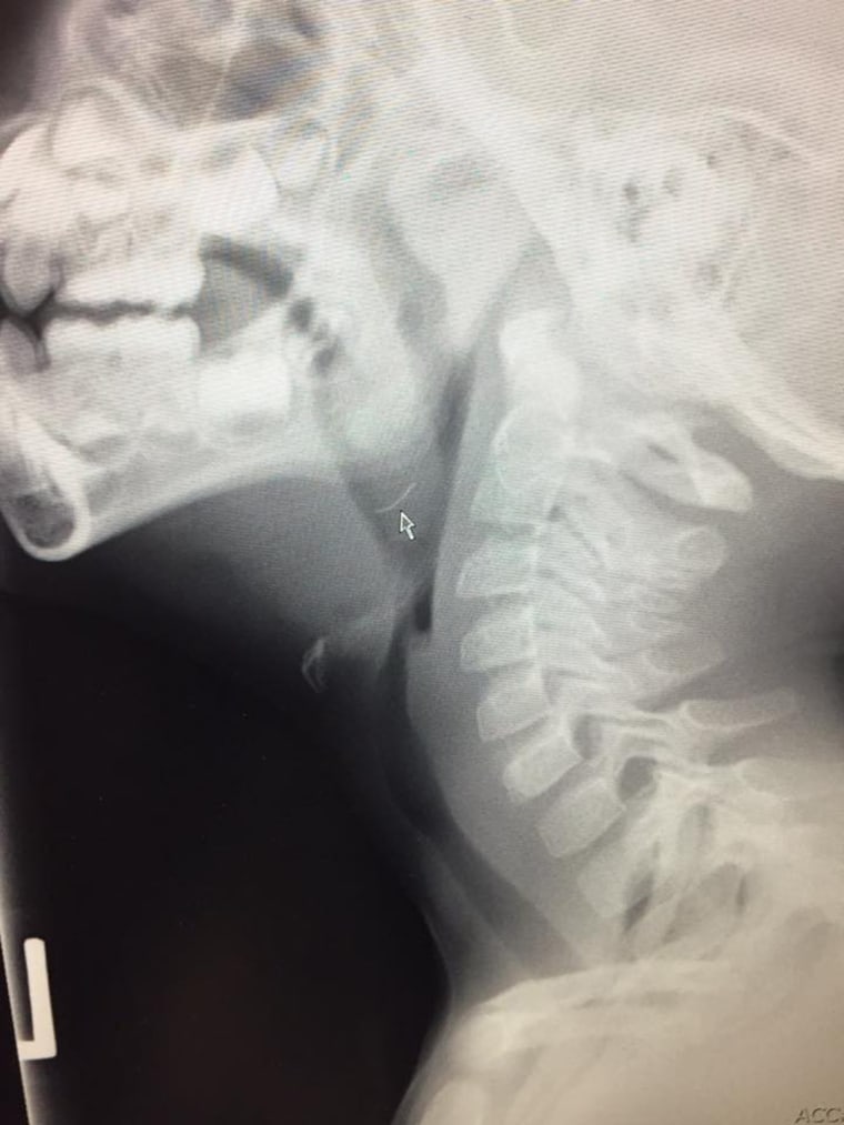 An X-ray of 4-year-old Oliver Schenn shows the metal bristle lodged in his throat.