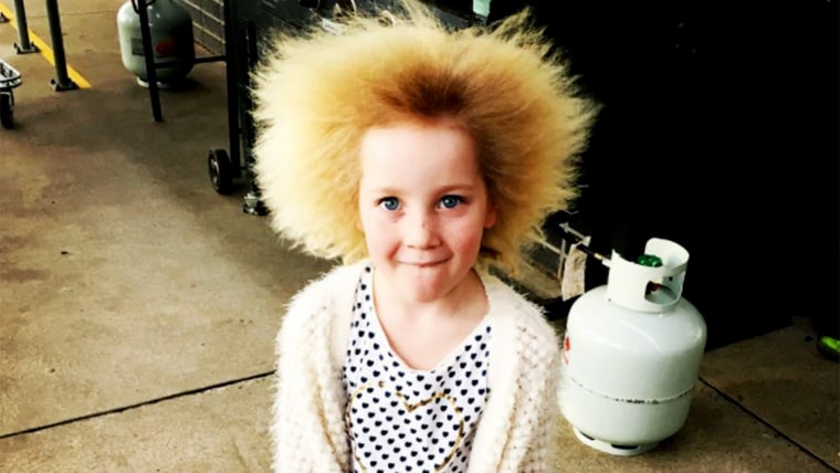 Shilah Yin has uncombable hair syndrome