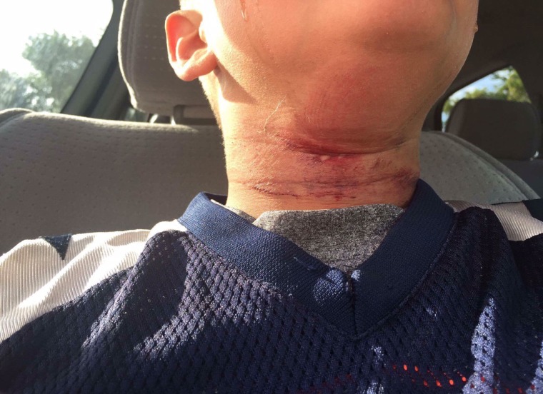 Image: Eight-year-old boy who was treated for rope burns in Claremont, New Hampshire