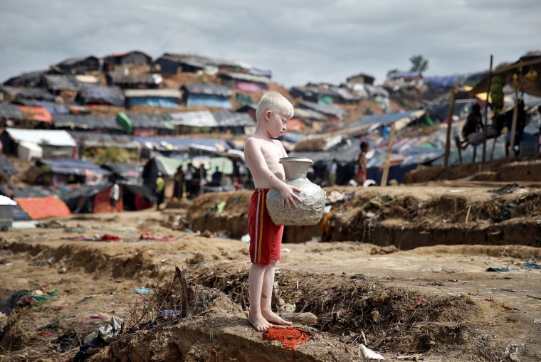 Image: An albino Rohingya refugee poses for a picture in Cox's Bazar, Bangladesh
