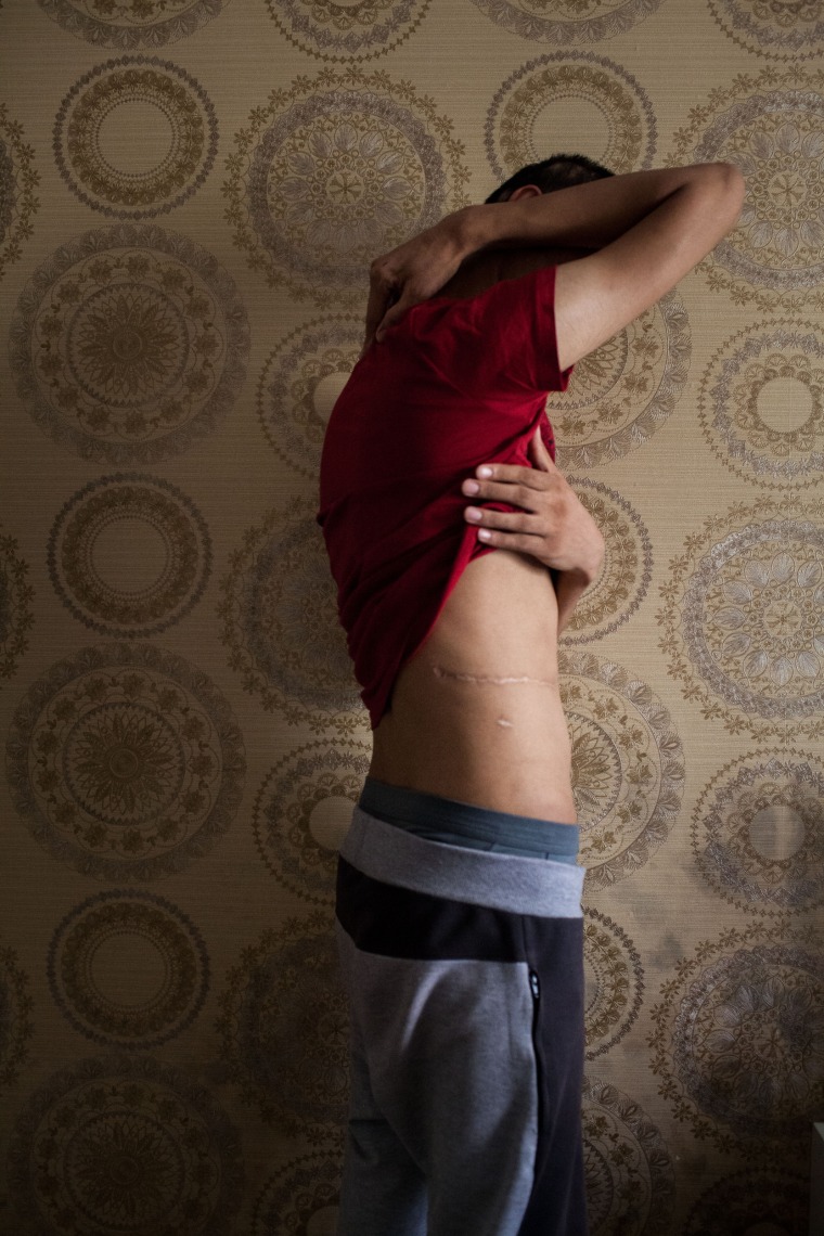 Image: Danial, a gay man from Iran, shows the scars on his body