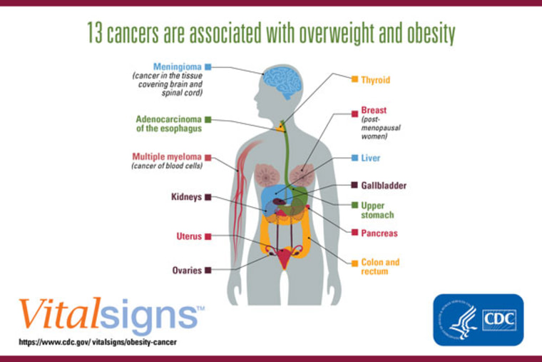 Obesity is a major cause of cancer