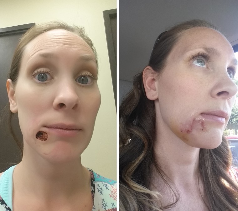 Woman Shares Story Of Pimple That Turned Out To Be Squamous Cell Carcinoma