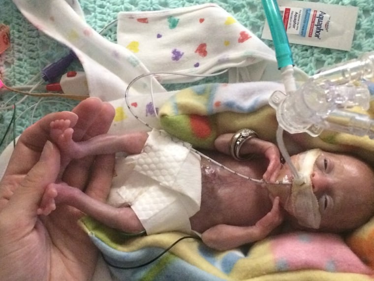 Baby Stensrud is believed to be the most premature surviving baby ever.
