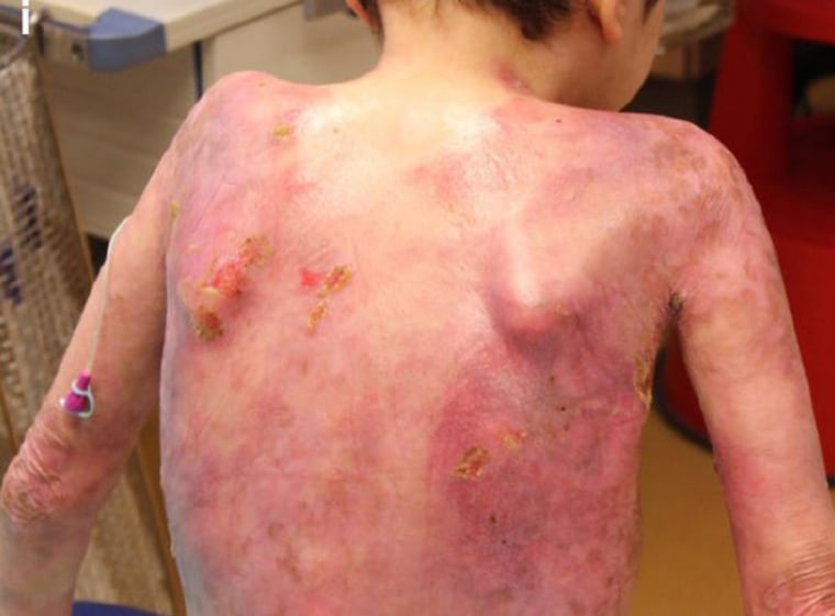 Gene Therapy Skin Grafts Save Boy With Rare Disease