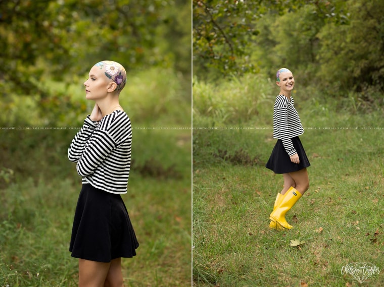 Teen embraces hair loss in senior photos