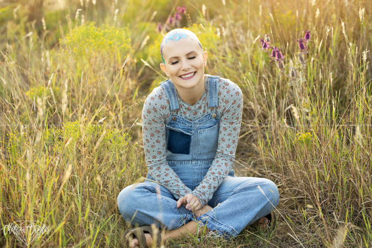 Teen embraces hair loss in senior photos