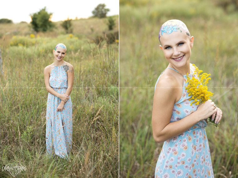 Teen embraces hair loss in senior photos