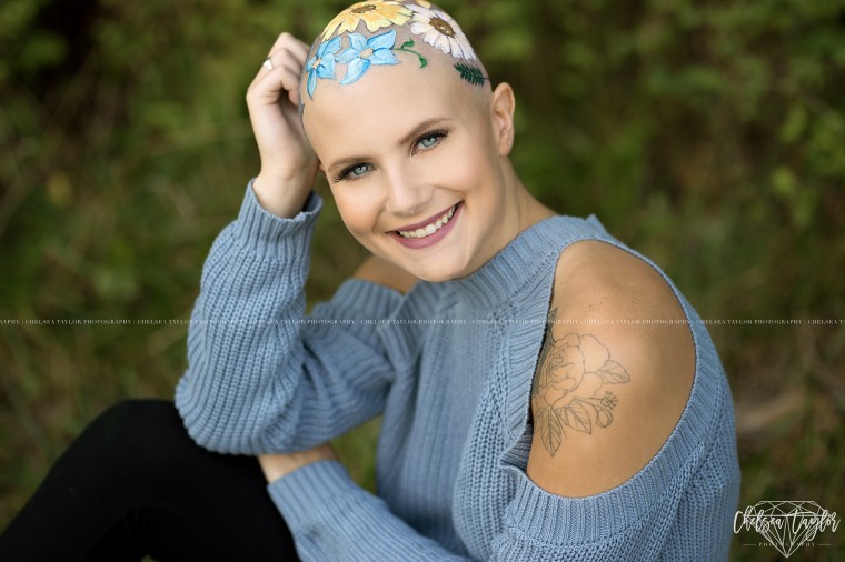 Teen embraces hair loss in senior photos