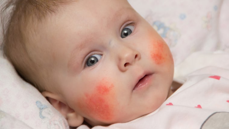 Cute baby with Eczema