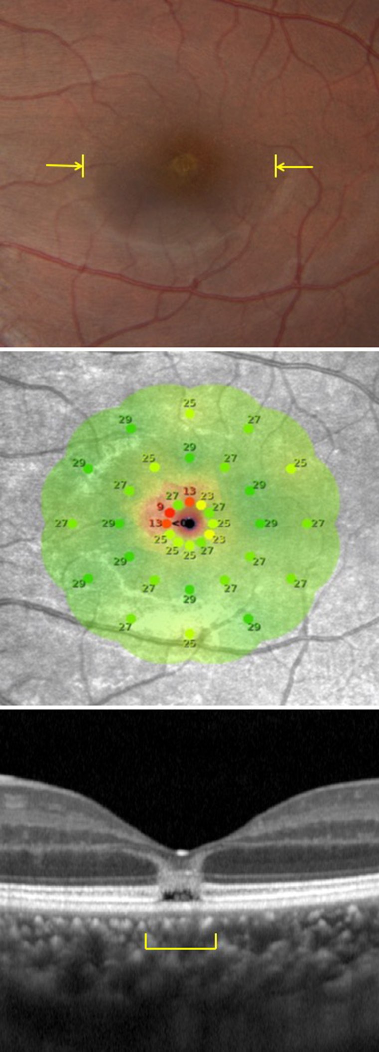 New technology allowed doctors to see for the first time what happens when someone experiences solar retinopathy. 