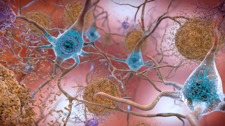 A new study projects that 46.7 million Americans have evidence they are at risk of Alzheimer's