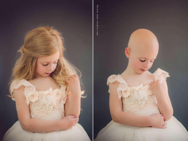 While Riley was born with a full head of hair, she was completely bald by 15 months because of alopecia.