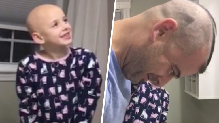 Dad Shaves Head to Cheer Up Daughter Who Lost Hair to Alopecia
