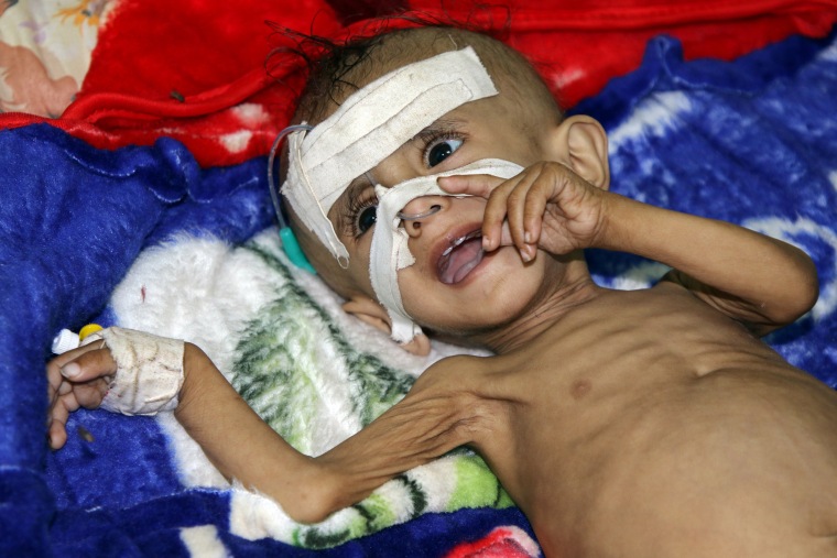 Image: One-year-old Sameer al-Dhanbari, who suffers from severe malnutrition, lies on a bed at a hospital in Houta
