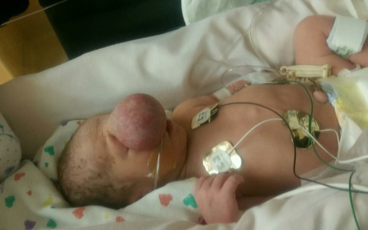 Zak Riegel was born with an encephalocele, a rare birth defect