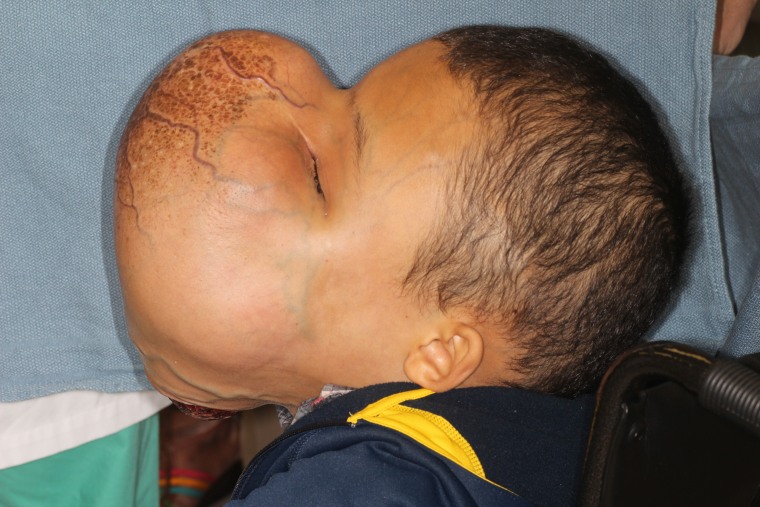 Man with huge face tumor reveals surgery results