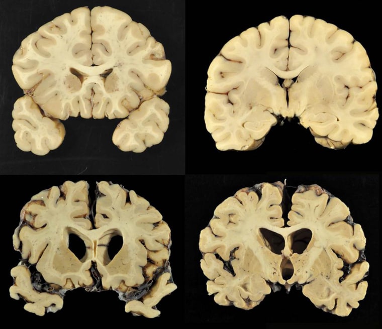 Sections from a normal brain, top, and from the brain of former University of Texas football player Greg Ploetz, bottom, in stage IV of chronic traumatic encephalopathy. 