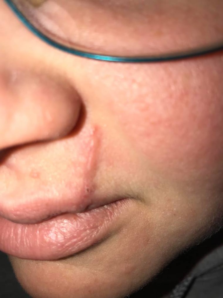 Even though her lip is healing well, Mallory Lubbock believes she will always have a scar on her face from skin cancer.