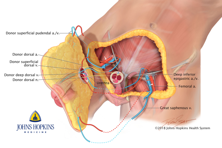 Image: Penile Transplant