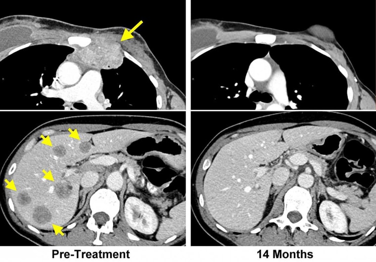 Image: Before and after MRIs with TIL therapy