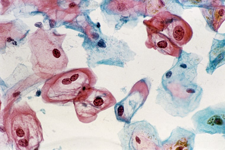 Image: LM of cervical smear revealing HPV infection