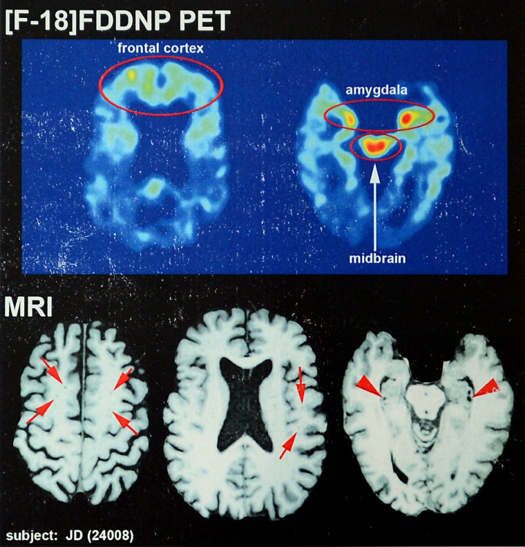 Image: chronic traumatic encephalopathy