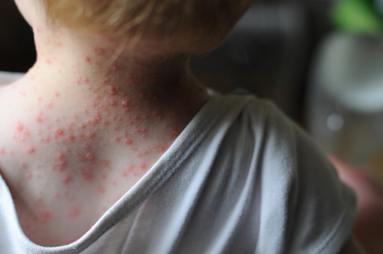 Parents may think chickenpox is a minor illness, but there are a number of serious complications. 