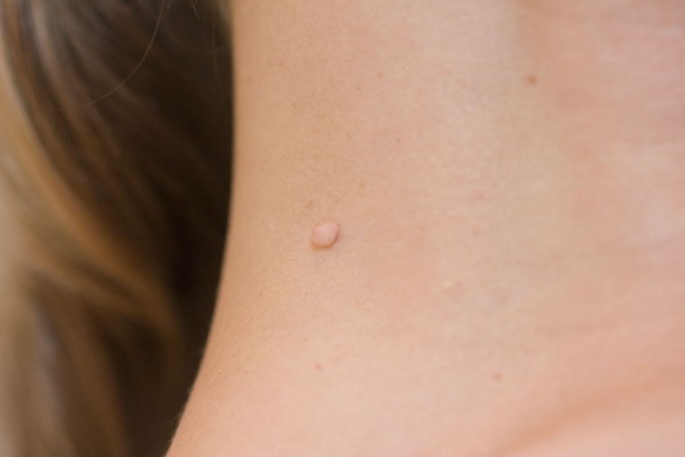 Closed Up of Skin Tags or Acrochordon Under the Armpit Stock Photo