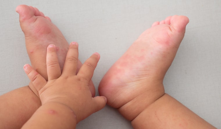 Hand Foot And Mouth Disease Symptoms Causes And Treatments