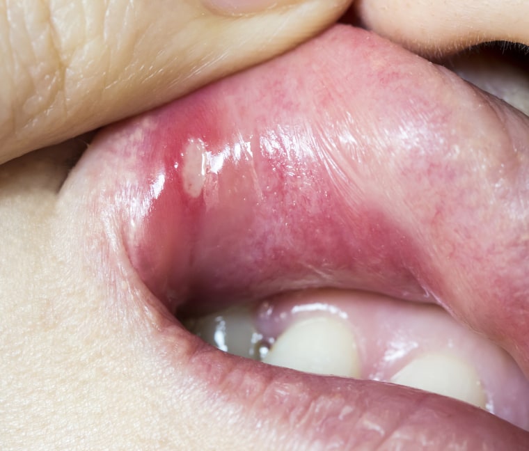 Mouth ulcer, canker sore, canker sore on lip, how to get rid of canker sores