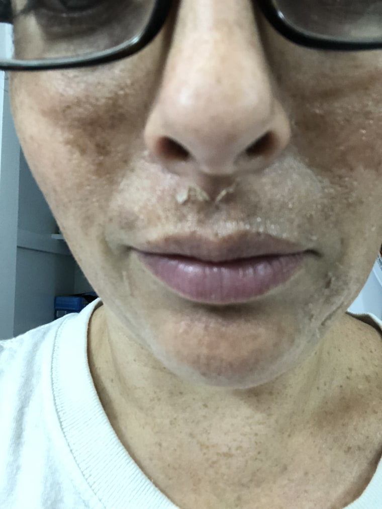 Skin Peel