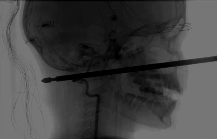 An X-ray showing the meat skewer through Xavier Cunningham's face.