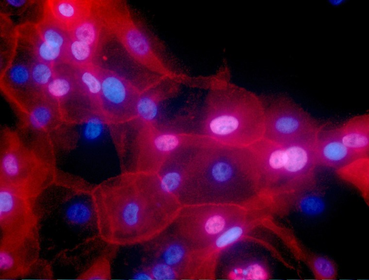 Image: A culture of human breast cancer cells