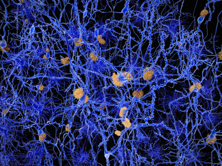 Alzheimers disease, illustration