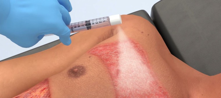 ReCell, a spray-on skin product, is designed to treat burns with a slurry of the patient's own skin cells.