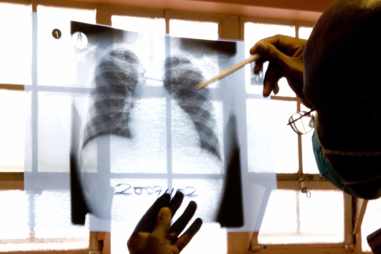 Image: a doctor examines chest X-rays at a tuberculosis clinic