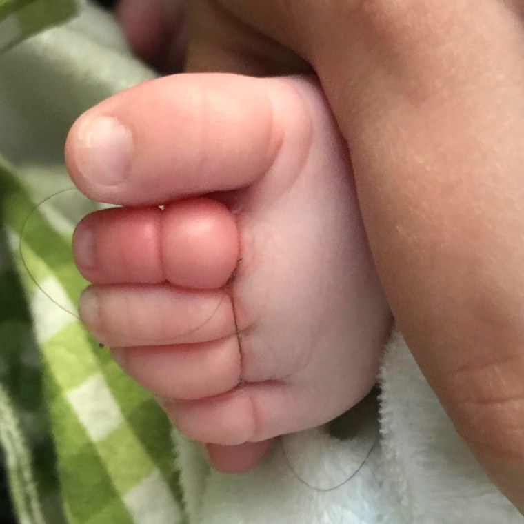 Mother's hair wrapped around her son's toe, cutting off circulation.